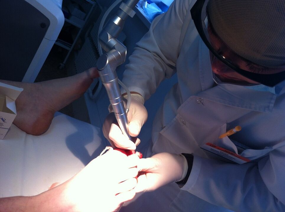 Laserowe leczenie mykozy
